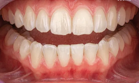 Depois - Apinhamento